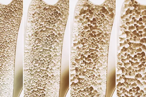 Darstellung brüchige Knochen (Osteoporose)